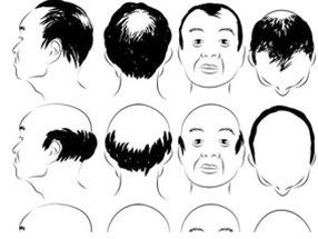 在南陽，選擇種植頭發價格怎么說？