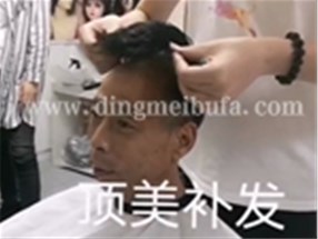 頂美補發-假發定制