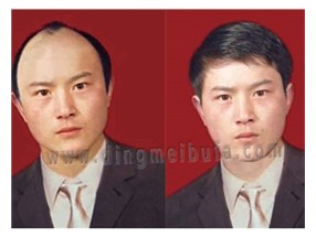 怎樣治療脫發？男士治療脫發小秘方